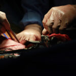 Hospital Clínico U. de Chile logra hito con su primer trasplante hepático con donante vivo transplante de hígado